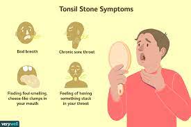 Tonsil Stones and Halitosis